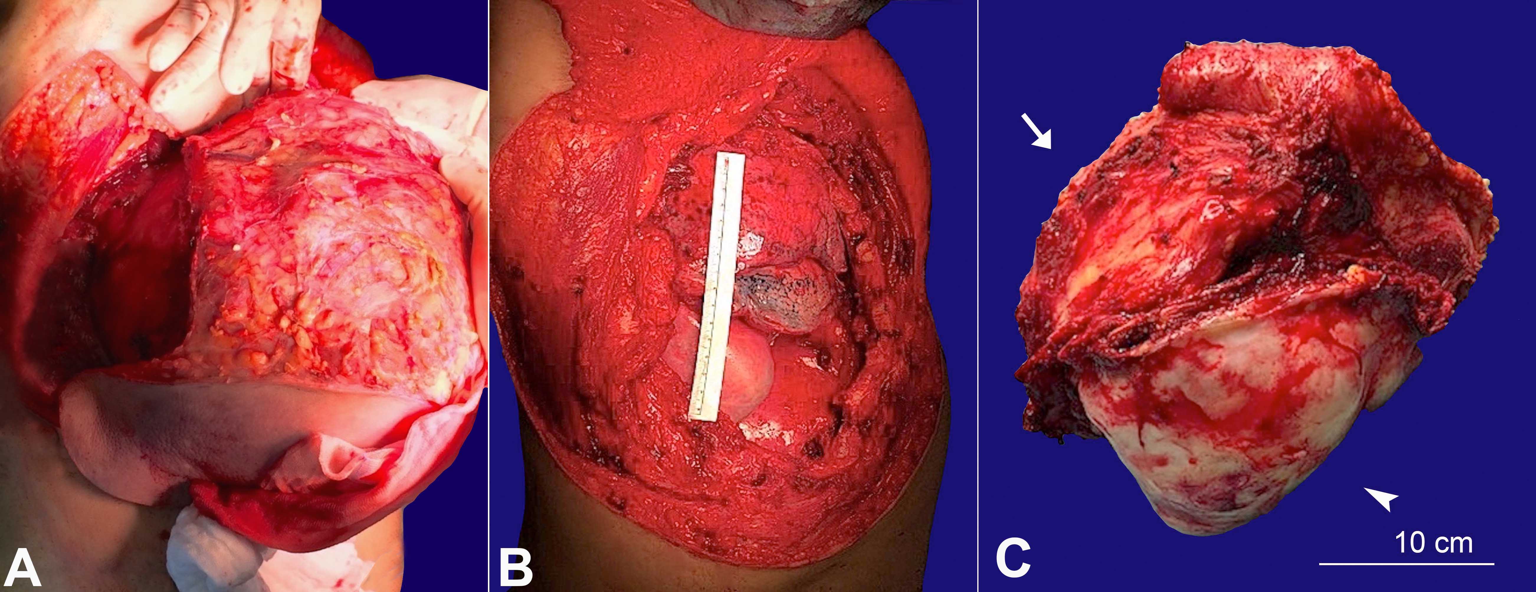 A &ndash; Intraoperative view of wide en bloc tumor excision; B &ndash; Large anterolateral chest wall defect; C &ndash; Resected tumor specimen (625 cm2): extra-thoracic (arrow) and intra-thoracic tumor extension covered with parietal pleura (arrowhead), separated by the transverse section of the third to sixth ribs.