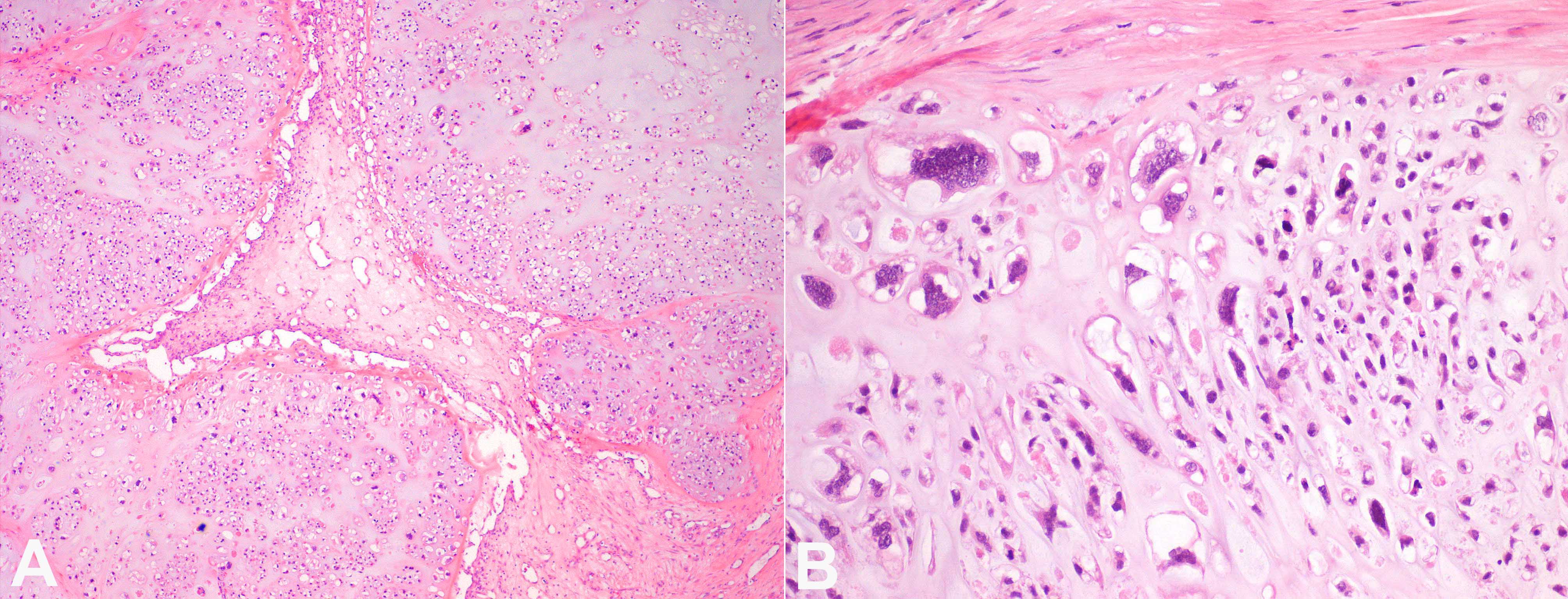 Photomicrographs of the tumor: A &ndash; Conventional chondrosarcoma grade III, multinodular, with variable cellularity and pleomorphism (H&E, 10X); B &ndash; Areas of marked cellular pleomorphism (H&E, 40X).
