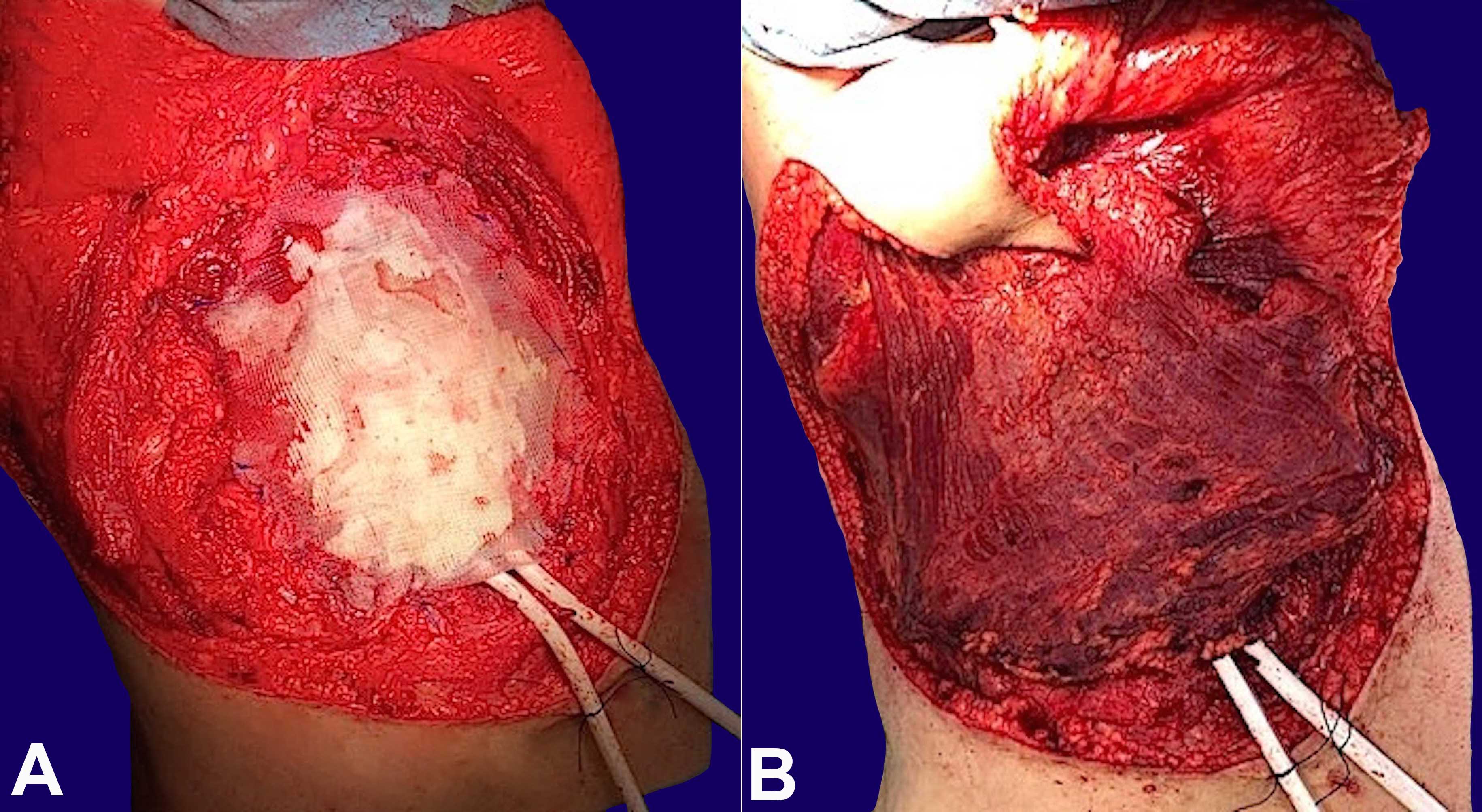 A &ndash; Reconstruction of the chest wall skeletal component with MMA-polypropylene mesh sandwich technique; B &ndash; Soft tissue coverage with a pedicled LD muscle flap. LD = latissimus dorsi; MMA = methyl methacrylate.