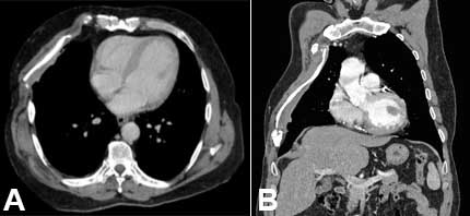 Post-operative computed tomography scan. Axial (A) and coronal (B) planes (1.5-year follow-up). There was no evidence of recurrence. Stable prosthetic skeletal support and good thoracic contour with pedicled muscular flap coverage is shown.