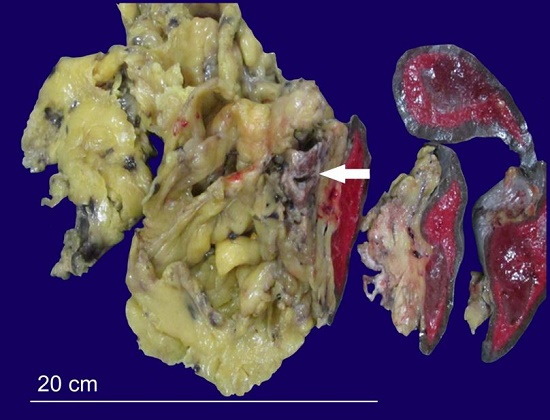 Gross appearance of the pancreatic tumor. A well-circumscribed cystic lesion measuring 3 &times; 2 &times; 1 cm is depicted in the tail of the pancreas.