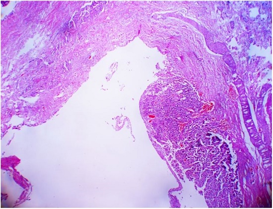 Photomicrograph of the cystic tumor showing a large cystic tumor with a focal lobular arrangement of tumor cells in the cyst wall (H&E, 4X).