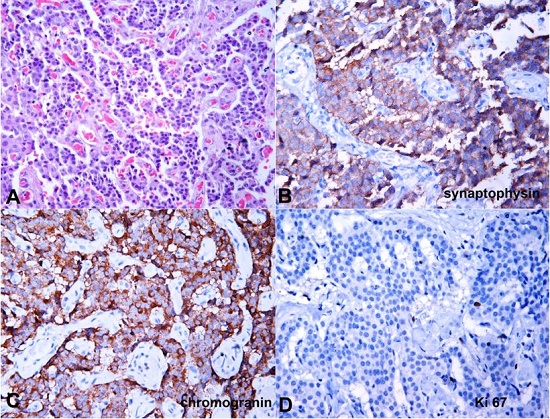 Photomicrographs of the tumor. A &ndash; Lobular arrangement of tumor cells (H&E, 40X); B &ndash; Immunopositivity for synaptophysin (40X); C &ndash; Immunopositivity for chromogranin (40X); D &ndash; Ki-67 labeling 3% (40X). 