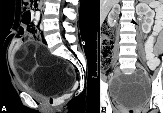 Abdominal CECT – A – Sagittal plane depicting a large multi-septated cystic lesion in the pouch of Douglas splaying and displacing the uterus anteriorly; B – Coronal plane depicting the hydronephrosis with dilated ureter (white arrowhead).