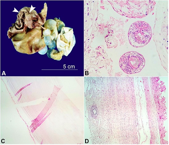 A – Gross view of the surgical specimen with the ruptured cystic mass (arrowheads), and multiple vesicles; B – Photomicrographs of the brood capsules with scolices within the cyst lumen (H&E,400X); C – Section from the cyst wall shows thick laminated membrane (H&E,400X); D – Section of the ovarian tissue showing foreign body giant cell reaction (H&E,400X).