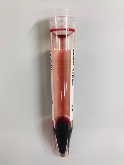 Serum of the patient at presentation.