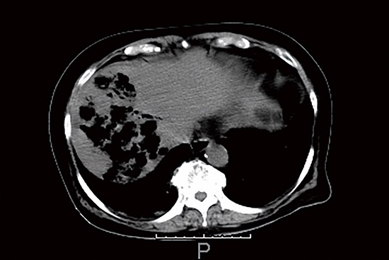Non-contrast computed tomography of the abdomen. Irregular-shaped cavities containing abundant gas in the right lobe of the liver.