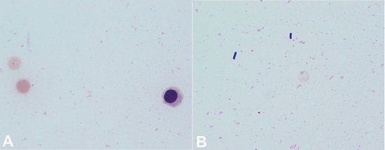 Microphotographs of the peripheral blood smear. A – A spherocyte showing loss of central pallor, a “dehemoglobinized” ghost cell, and an erythroblast are apparent. Note that intact red cells are no longer identified (Giemsa staining, 1000X); B – “Boxcar-shaped” bacilli are clearly demonstrated in the background of ghost cells and fragments of red cell membrane (Giemsa staining, 1000X).