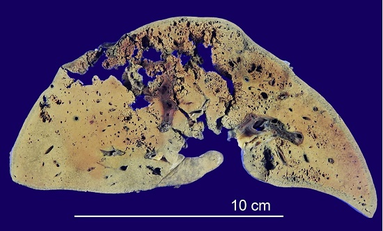 Abscesses featuring a honeycomb structure with gas bubbles, affecting the right and left lobes of the liver.