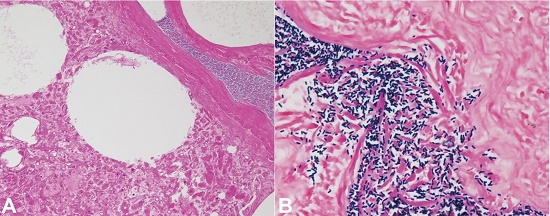 Microphotographs of the liver. A – Coagulation necrosis is evident in association with bleb formation. Bacterial proliferation is apparent in the right upper portion (H&E, 100X); B – Gram staining reveals marked proliferation of boxcar-shaped gram-positive bacilli. Note that inflammatory cell infiltration is lacking (400X).