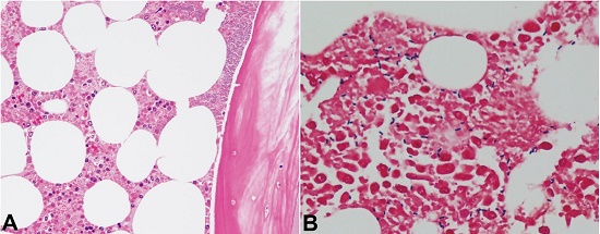 Microphotographs of the bone marrow. A – Necrosis of both hematopoietic cells and fat cells is apparent (H&E, 200X); B – Many boxcar-shaped gram-positive bacilli are confirmed (Gram staining, 400X).