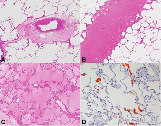 Microphotographs of the lung. A – Eosinophilic transudate around the pulmonary arteriole (H&E, 40X); B – Eosinophilic transudate is observed in the limited area within a pulmonary lobule (H&E, 40X); C – Area of panlobular edema (H&E, 40X); D – Fat globules are demonstrated within the pulmonary arterioles and capillaries of the interalveolar septa (Sudan III staining, 100X).