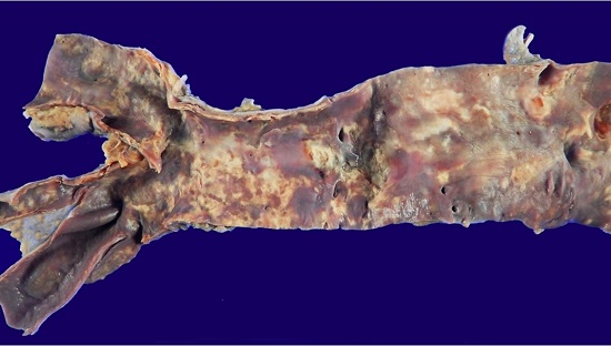 Aorta: moderate atherosclerosis; endothelium with a burgundy color, indicating massive intravascular hemolysis.