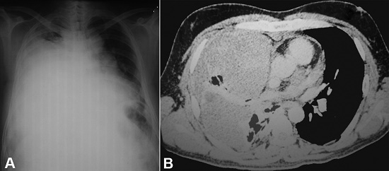 A – Chest X-ray showing a homogenous opacity in right hemithorax, and contralateral mediastinal shift; B – Thoracic CT showing a pleural based large non-enhancing mass reaching the chest wall anteriorly. Note the preservation of the fat planes. Posteriorly the mass abuts and distorts the right upper lobe bronchus, stretches the ascending branch of right superior pulmonary vein, medially abuts the superior vena cava in its distal course and the ascending aorta at its proximal course and superiorly displaces the horizontal fissure causing the collapse of the middle lobe.