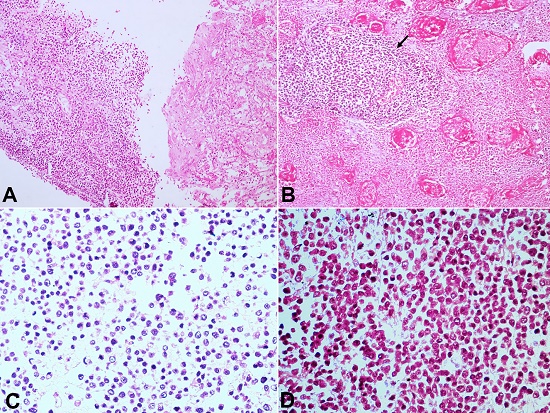 Photomicrographs of: A – Antemortem Tru-cut biopsy of the thoracic mass showing proliferating round cells (H&E stain, x200); B – Photomicrograph from post mortem lung section shows sheets of small round blue cells having peritheliomatous arrangement with extensive areas of necrosis (H&E stain, x200); C and D – the round to oval cells have stippled chromatin, indistinct nucleoli, scant cytoplasm(H&E stain, x200).
