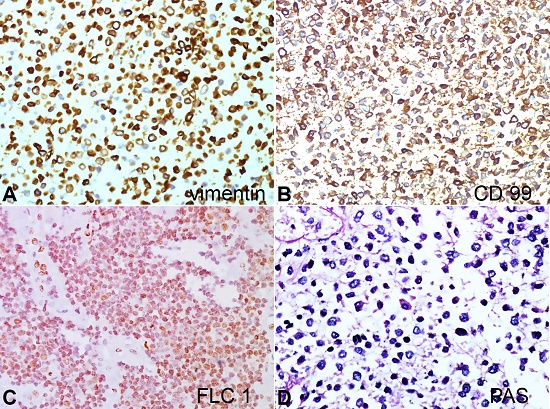 Photomicrograph of the tumor showing the immunohistochemical expression with strong positivity of tumor cells for vimentin (A), CD99 (B), FLI1 (C) and on Periodic Schiff stain (D) magenta cytoplasmic uptake. (x400 magnification).