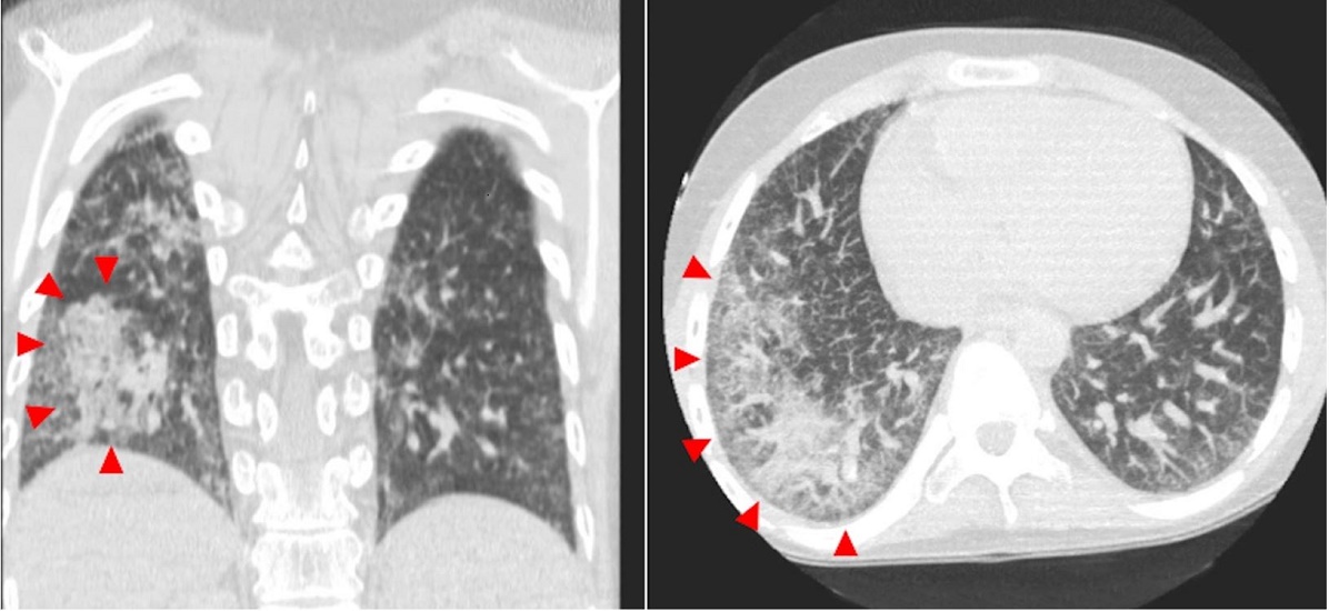 CT scan of the chest showing extensive reticulation, interlobular septal thickening, and patchy confluent areas of peripheral airspace consolidation on the right lung (red arrowheads).