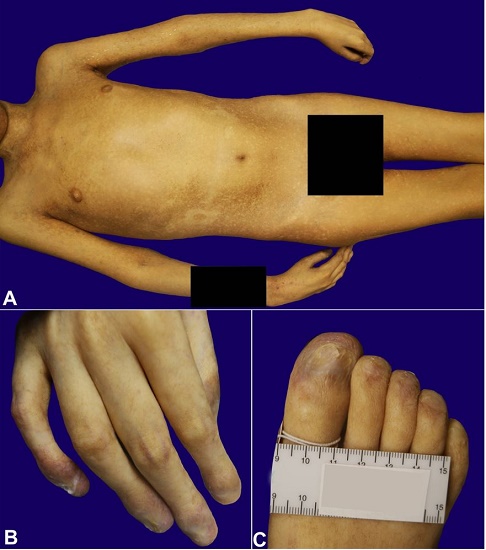 A &ndash; Macular areas of hypopigmentation with a reticulated pattern observed at the external examination (fig. 2). B and C &ndash; Note the absence of nails with exposed nailbed and dystrophic nails.