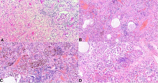 Photomicrographs of the lungs. A &ndash; Prominent fibrosis with increased dilated vascular channels (H&E, 100x); B &ndash; Mild thickening of the pulmonary arterioles, consistent with pulmonary hypertension (H&E, 100x); C and D &ndash; Diffuse alveolar damage with acute and organizing pneumonia in addition to numerous hemosiderin-laden macrophages are present (both H&E, 200x).