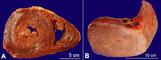 Gross view of the: A &ndash; Left and right ventricular hypertrophy; B &ndash; liver with firm granular parenchyma, with gross areas of nodule formation.