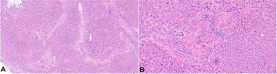 Photomicrographs of the liver with: A &ndash; focal areas of bridging fibrosis and nodule formation (H&E, 40X); B &ndash; Biliary duct proliferation and patchy increased chronic inflammation observed in other portal triads (H&E, 40X).