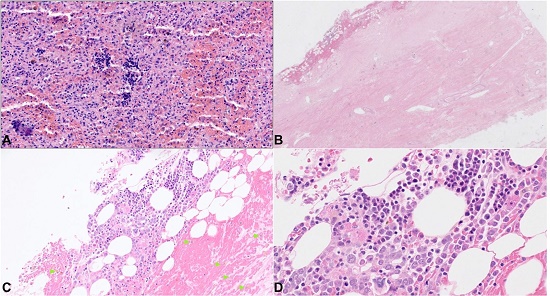 Photomicrographs of the: A &ndash; Spleen with foci of extramedullary hematopoiesis and lipid-laden macrophages; B &ndash; dura mater with small area of epidural hemorrhage (H&E, 20X) and in C &ndash; scattered hemosiderin-laden macrophages(H&E, 100X; green arrowheads); D &ndash; within the hemorrhagic area, numerous erythroid precursors, megakaryocytes, and other immature hematolymphoid cells are present, consistent with trilineage extramedullary hematopoiesis (H&E, 400X).