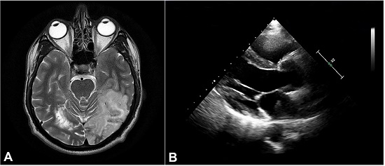 A &ndash; NCCT brain showing an acute wedge-shaped infarct in left hemisphere, B &ndash; Transesophageal echocardiography (TEE) showing a left atrial mass arising from Interatrial septum.