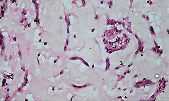 Photomicrograph of the surgical specimen showing the microscopic features of atrial myoma: Stellate shaped myxoma cells embedded in a myxoid stroma.