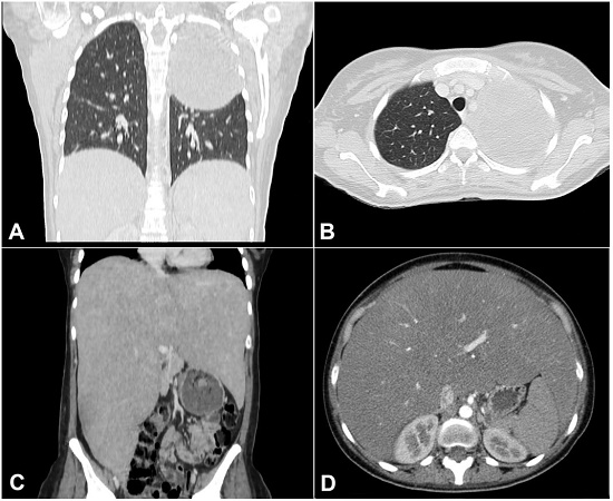 A – Chest CT scan Coronal plane – and B – axial plane -revealing a large mass in the left hemithorax; C – abdominal CT scan coronal plane and D axial plane - showing remarkable hepatomegaly.