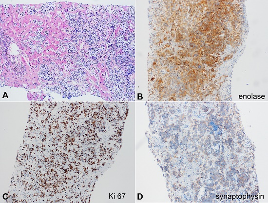Photomicrographs of the liver biopsy. A - metatstatic neroblastoma in the liver parenchyma (H&E), B - enolase positive reaction, C - Ki 67, D - synaptophysin weak positive reaction.