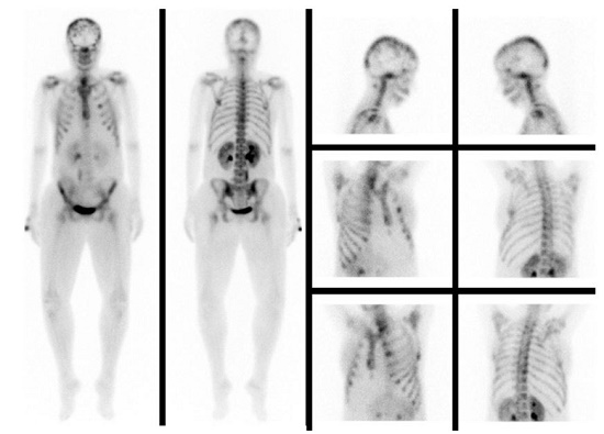 Bone scintigraphy with increased radiotracer uptake in the skull, third left costal arch, sternum, and T9.