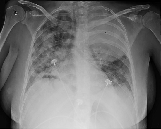 Chest radiography in day 4 of admission, prior to ICU admission, and subsequent orotracheal intubation. D stands for right side.