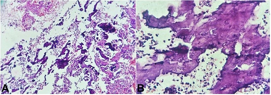 Photomicrograph of the endometrial biopsy (A and B) shows stroma and bone tissue and calcification, (H& E, 40X).