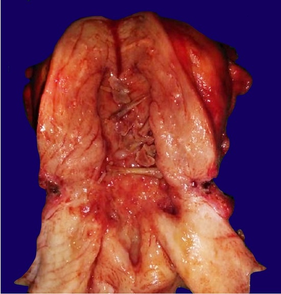 Gross view of the surgical specimen showing a simple hysterectomy with retained fetal bones in the endometrial cavity.