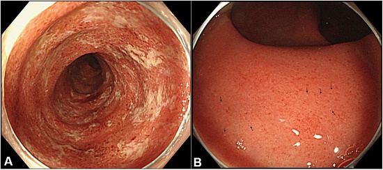 Photograph of colonoscopy at 21 weeks postpartum. A – Diffuse erythematous mucosa with patchy mucous adherences was observed in the sigmoid colon; B – Diffuse inflammation without normal vascular pattern was observed in the rectum. Multiple yellow-white color spots (erosions) (arrows) were observed.
