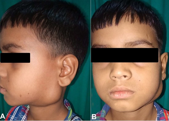 External view of the neck showing swelling over left side of neck In the Infra auricular region (A &ndash; lateral and B &ndash; frontal views)