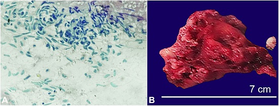 A &ndash; Photomicrograph of the FNA cytology showing spindle cells in clusters and singly scattered with atypical mitosis in a hemorrhagic background; B &ndash; Gross specimen of excised tumor showing globular solid mass.
