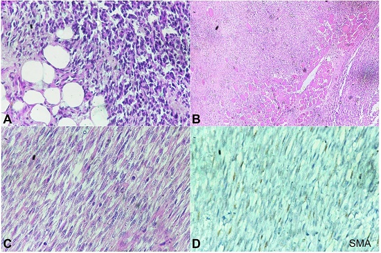 Photomicrographs of the tumor. A &ndash; Tumor cells invading the subcutaneous fat (H&E, 20X), B &ndash; muscle infiltration by the tumor (H&E, 20X); C &ndash; Spindle cell tumor with atypical mitosis (H&E, 40X), D &ndash; negative reaction to SMA (40X)