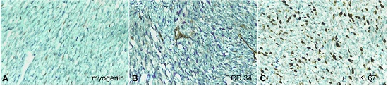 Photomicrographs of the tumor. A &ndash; negative reaction for myogenin (40X); B &ndash; negative reaction for CD 34 (40X); C &ndash; Ki67 index of 50-60% (40X).