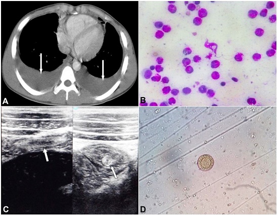A &ndash; Thoracic CECT showing bilateral pleural effusion (white arrows); B &ndash; Pleural fluid smear - showing highly cellular fluid with a predominant presence of eosinophils; C &ndash; Abdominal ultrasonography showing the intestinal worm infestation (white arrows); D &ndash; Stool microscopic examination showing ova of Teania sp.