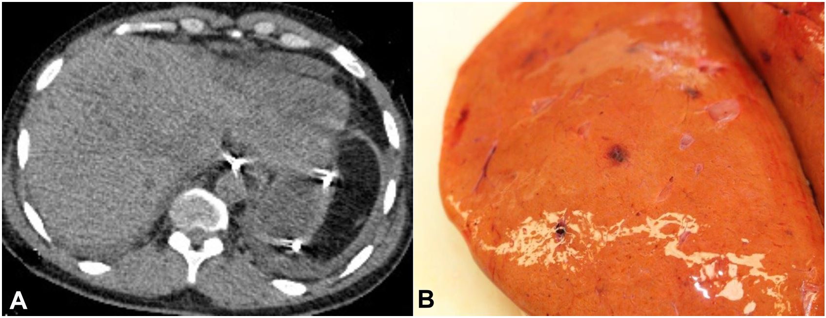 A &ndash; Antemortem CT scan of the abdomen showed innumerable low attenuation lesions throughout the liver, B &ndash; At autopsy, multiple hemorrhagic foci were observed throughout the liver.