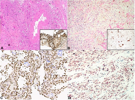Comparison between Case 1, left column, and Case 2, right column. A and B &ndash; autopsy liver showing atypical spindle cell proliferation (H&E, 20X), with CD31 positivity in antemortem liver biopsy (a, insert) and post-mortem liver sample (b, insert), C and D &ndash; HHV8 positivity is observed in both cases.