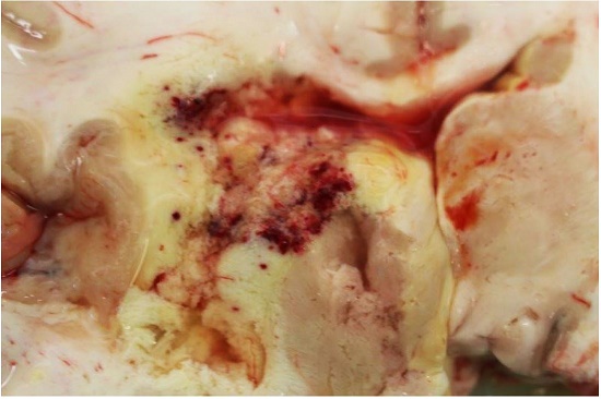 Gross view of the brain showing multiple areas of hemorrhagic infarction.