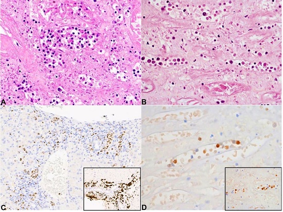 Comparison between Case 1, left column, and Case 2, right column. A and B &ndash; autopsy samples showing intravascular lymphoid proliferation (H&E, 20X), C &ndash; HHV8 positive intravascular large B-cell lymphoma present in antemortem liver biopsy; and D &ndash; post-mortem kidney, both with MUM1 positivity (insert).