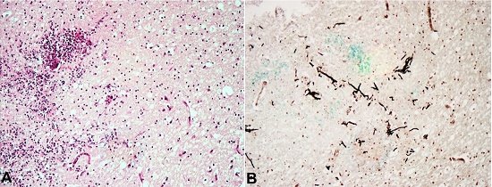 Photomicrographs of the brain demonstrating: A &ndash; inflamed brain tissue (H&E, 10X); B &ndash; fungal organisms with an acute angle of hyphal division, consistent with mucormycosis (Grocott, 10X).