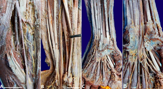 Photographs of the case.A &ndash; Cubital fossa; B &ndash; Forearm presentation; C &ndash; Wrist presentation; D &ndash; Opened transverse carpal ligament: 1) radial artery; 2) radial recurrent artery; 3) ulnar artery; 4) common interosseous artery; 5) persistent median artery; 6) pronator teres muscle; 7) median nerve; 8) palmaris longus tendon; 9) transverse carpal ligament (flexor retinaculum); 10) flexor digitorum superficialis tendons; 11) flexor pollicis longus tendon; 12) radial artery in anastomosis with the common digital artery of the index finger; 13) common digital palmar artery from the persistent median artery; 14) common digital palmar arteries from the ulnar artery. Scale bar A) and D) are 3cm; B) and C) are 5cm.