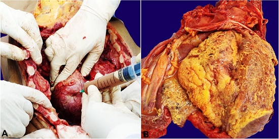 Gross view of the: A &ndash; Opened thoracic cavity with pericardial sac puncture. Note the purulent fluid being drained; B &ndash; Gross view of the heart -purulent pericarditis.