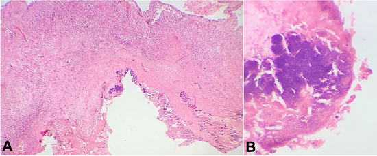 Photomicrograph of the mitral valve. A &ndash; shows the vegetation with bacterial colonies (H&E stain, 10x); B &ndash; shows a detail of the vegetation with the bacterial colonies (H&E stain, 40x).