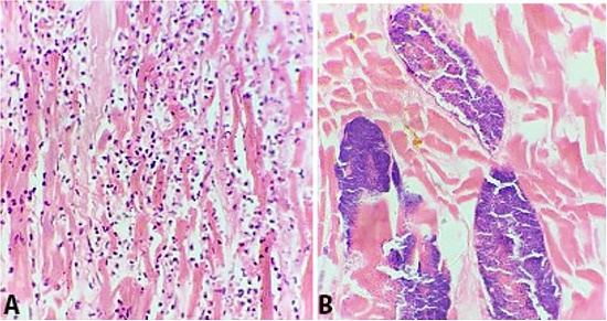 A and B Photomicrographs of myocardial abscess in left ventricular wall showing neutrophilic infiltrate in the cardiac muscles (A) and bacterial colonies in the myocardium (B) (H&E, 40x).