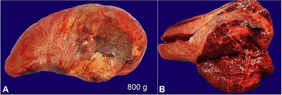 A &ndash; Gross view of the spleen. Note pale areas indicating septic infarcts over the external surface (weight reference range 112 g); B &ndash; Cut surface showing septic infarcts and acute splenitis.
